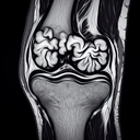 МРТ колінного суглобу