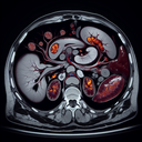 МРТ селезінки